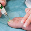 TOENAIL FUNGUS LASER SURGERY